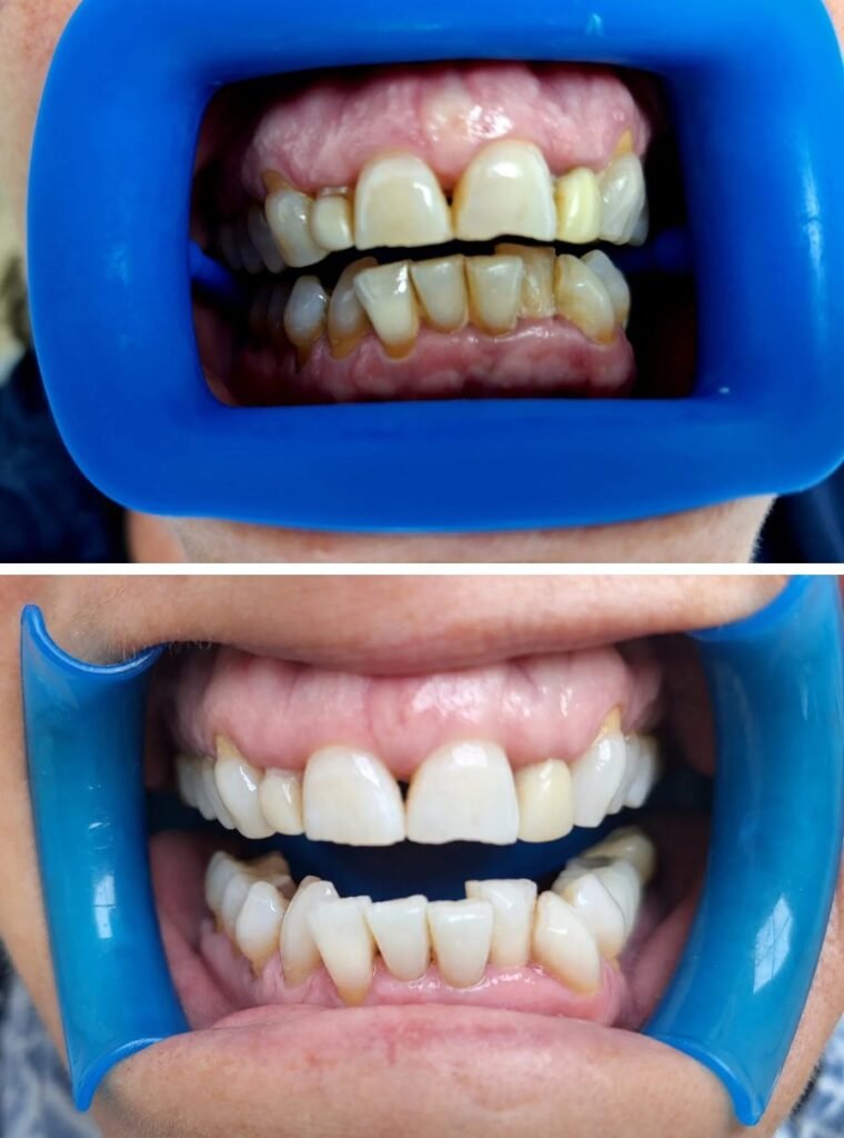 Blanquejament dental a Dental Sant Andreu: abans (a dalt) i després (a baix)